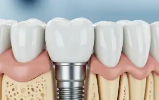 Rökare och implantat – risker och förebyggande åtgärder